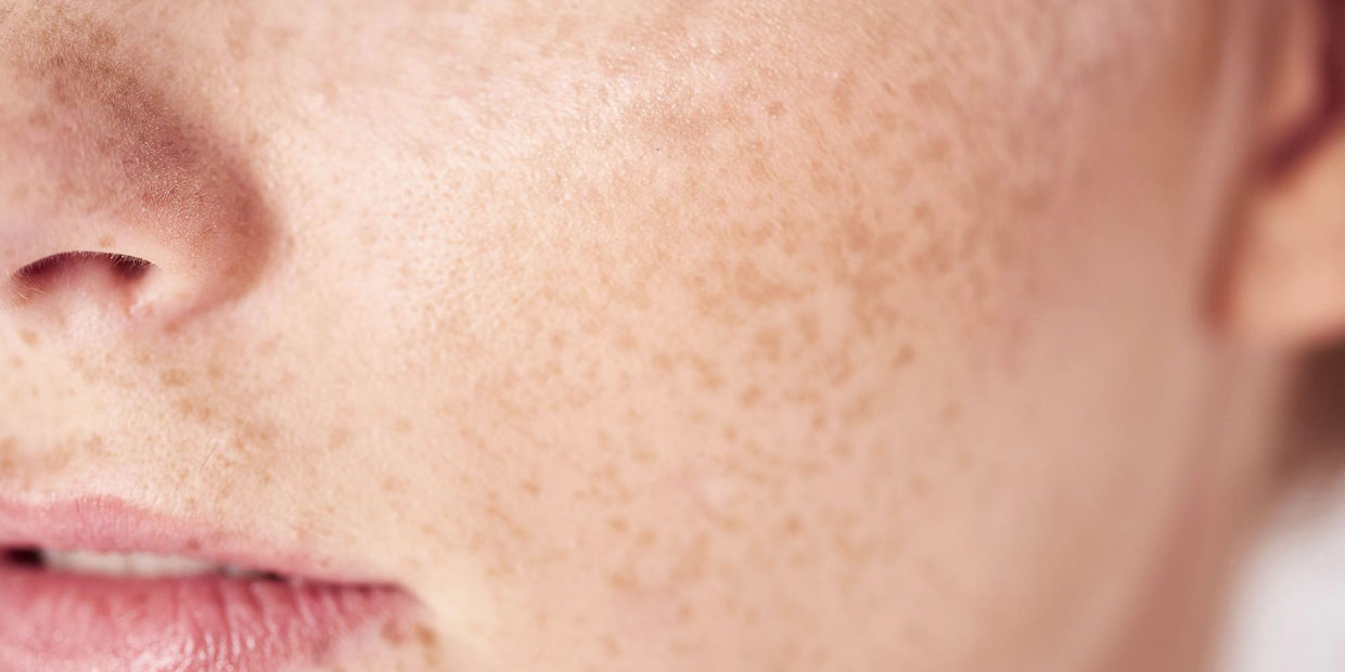 профілактика пігментації шкіри обличчя